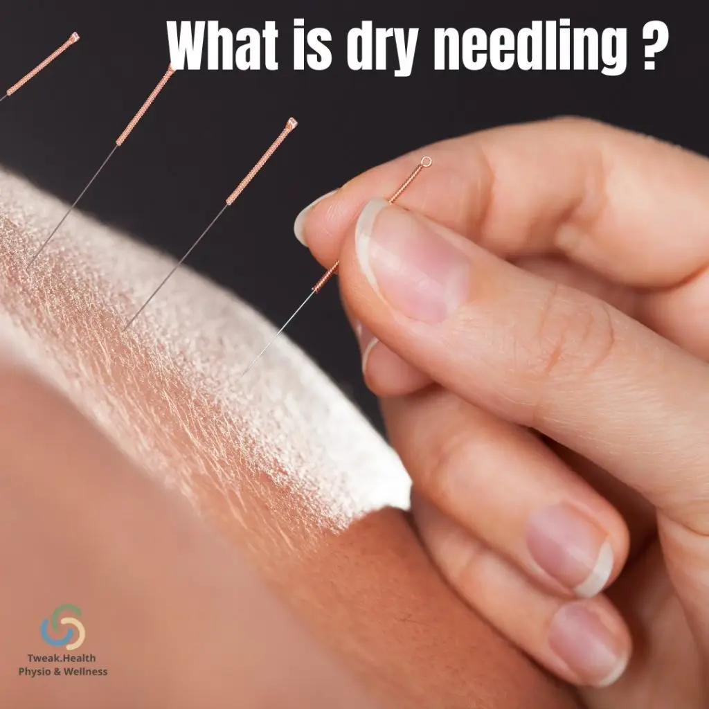 Therapist doing dry needling on a patient