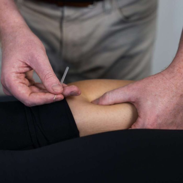 Dry needling for muscular pain in a physiotherapy session